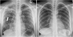 Tb is an airborne disease caused by the bacteria mycobacterium tuberculosis and mycobacterium bovis. Yield Of Chest X Ray Tuberculosis Screening Of Immigrants During The European Refugee Crisis Of 2015 A Single Centre Experience Springerlink
