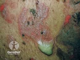 Image result for Pemphigus