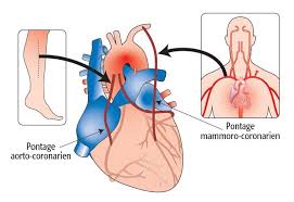 Tout cela se trouve au coeur de ce . que fait du canada ce qu'il est et ce qu'il doit être: Pontage Coronarien Institut De Cardiologie De Montreal