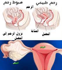 اعراض هبوط الرحم الخلفي كيف أعرف هبوط الرحم