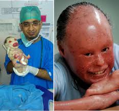 Image result for Ichthyosis