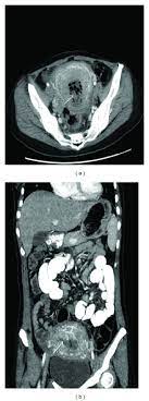 These tests are often unable to show specific findings to assist in the primary diagnosis. Ct Scan Of Abdomen And Pelvis Enlarged Uterus With A Markedly Download Scientific Diagram