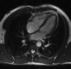 Image result for Cardiac MRI