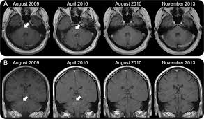 Current literature only reports a few cases journal of the belgian society of radiology. Clippers Induction And Maintenance Of Remission Using Hydroxychloroquine Neurology Neuroimmunology Neuroinflammation