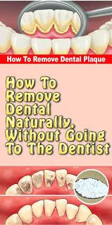 Grasp the tooth by using a small square of gauze. How To Remove Dental Naturally Without Going To The Dentist Dentaltartarremoval Dentist Health Dental