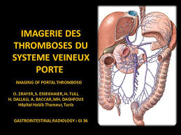 Imagerie Des Thromboses Du Systeme Veineux Porte Ppt Video Online Telecharger