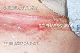 Image result for Intertrigo under breasts