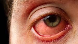 Image result for Eye Pain without Redness