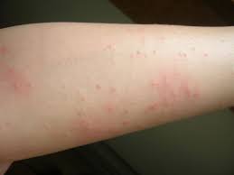 This is exactly why you need to identify the type of mite you're dealing with Mites On Humans Mite Infestation Cures
