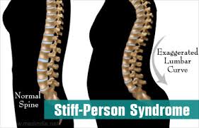 Stiff Person Syndrome Causes Symptoms Diagnosis Treatment Prevention