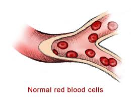 Sickling disorders include heterozygous (as) sickle cell trait, homozygous (ss) sickle cell disease, compound heterozygous states for hbs with haemoglobins c, d, e, or other structural variants and the combination of the sickle cell gene with different forms of thalassaemia. Sickle Cell Disease Babycentre Uk