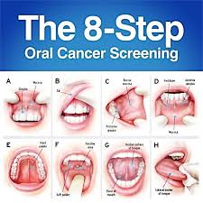 In the initial stages, mouth cancer can appear as a small white or red patch in the mouth. Everyone Should Acknowledge The Importance Of The Regular Oral Cancer Screening Aurora Yonge Dental