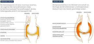Entstehung Und Ursachen Der Rheumatoiden Arthritis