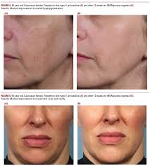 The Effects of a Daily Skincare Regimen