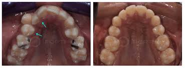 Maybe you would like to learn more about one of these? All You Need To Know About Orthodontic Retainers Braces Vs Retainers