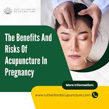 Acupuncture: What To Know Before You Go