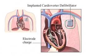 Surgery is necessary to implant an icd. Implantable Cardioverter Defibrillators Icds Can Be Lifesavers Lewisgale Physicians