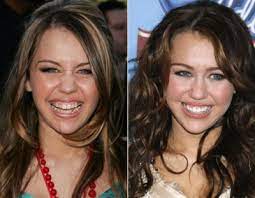 Hollywoodlacheln Ii Verblendung Mit Veneers Zahnersatz Ungarn