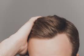 Dhea supplements are used by some people who believe they can improve sex drive, build muscle, fight the effects of aging, and improve some health conditions.but there isn't much evidence for many. Hair Loss And Adrenal Fatigue New York Ny