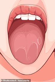 Check spelling or type a new query. Sydney Dentist Reveals The Signs To Look Out For Including White Patches Sore Lumps And Swelling Daily Mail Online