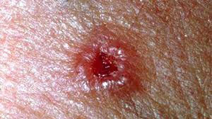 However, eruption of multiple lesions following exposure to various chemicals, including. What Is A Cherry Angioma Causes Treatment And Removal