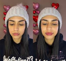 Get your lips done and your fillers with us! DM us for more info girls!