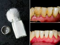 Como Quitar El Sarro De Los Dientes