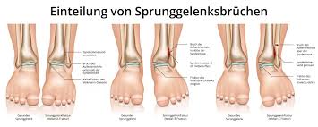 Medikamente anwenden, um schwellungen zu reduzieren tätigkeiten reduzieren, die schwellungen verstärken könnten Sprunggelenksbruch Ursachen Folgen Behandlung