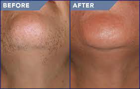 Laser hair removal is a fine balance of providing enough light energy to destroy hair follicles while leaving the outer skin undamaged other than superficial short term skin irritation and reddening. How Laser Hair Removal Works Laser Hair Removal Stl