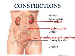 Constrictions Of Ureter Bladder Renal Failure Pelvis