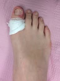 Thick nail clippers, 360 degree rotating blade Ingrown Toenails Alpine Foot Specialists