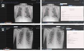 It is almost always the first imaging study ordered to evaluate for pathologies of the thorax, although further diagnostic imaging, laboratory tests. Automated Chest Radiograph Diagnosis A Twofer For Tuberculosis And Covid 19 Medrxiv