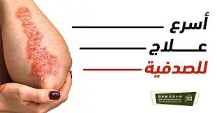 اسرع علاج للصدفية Hot Dog Buns Dog Bun Hot Dogs