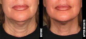 Build lean muscle in your face and neck by eating plenty of lean proteins found in poultry and seafood. A Non Invasive Skin Tightening Lifting Treatment Ultherapy