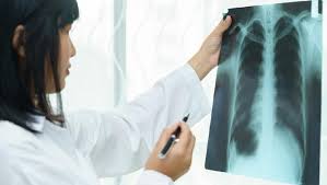 17 pengairan disebabkan jangkitan bakteria dirawat dengan antibiotik , 11 jangkitan tahap lebih parah boleh memaksa perawatan. Pneumonia Vs Tbc Sama Nggak Sih Yuk Tanya Dokter Paru