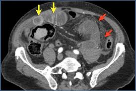 Image result for CT Intravenous Contrast
