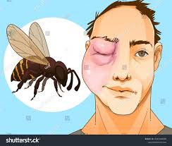 41 Stung By Bee Stock Vectors and Vector Art