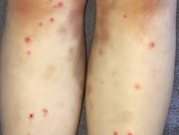 These rashes are known as ampicillin or amoxicillin rashes. Infectious Mononucleosis Dermnet Nz