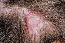 But in certain cases it can precipitate an acute form of hair loss. Ringworm Nhs