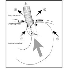 Check spelling or type a new query. Axial And Radial Forces That Affect A Hiatal Hernia Repair Download Scientific Diagram