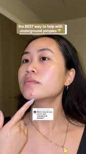 Best Ways to Treat Underground Pimples