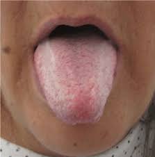 Image result for black hairy tongue symptoms