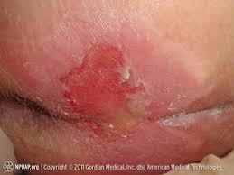 Check spelling or type a new query. Warning Images Of Pressure Sores Graphic