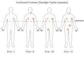 Lenfoid doku (boyunda, ciğerlerin arasındaki boşlukta, kasıklarda. Lenfoma Lenf Kanseri Nedir Belirtileri Ve Tedavisi Nasildir