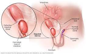 Inguinal Hernia - Symptoms And Causes - Mayo Clinic