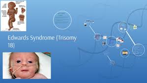 Edwards syndrome depicts a group of birth defects due to the presence of added genetic material. Edward Syndrome Trisomy 18 By Affaan Sohail