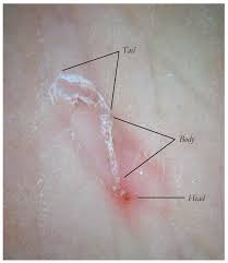 Image result for scabies on humans