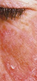 Google photos is the home for all your photos and videos, automatically organized and easy to share. Systemischer Lupus Erythematodes Antikorper Gegen Typ 1 Interferon Rezeptor Vermindert Krankheitsaktivtat Deutlich