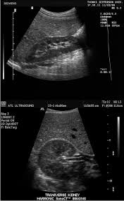 Quadratus Lumborum Muscle On Ultrasound Google Search Ultrasound Ultrasound Sonography Ultrasound Technician