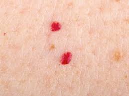 Cherry angiomas are also known as senile angiomas or campbell de morgan spots. What Are Red Moles And Are They Dangerous